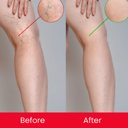 Vericose Vein Duo