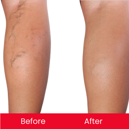 Vericose Vein Duo